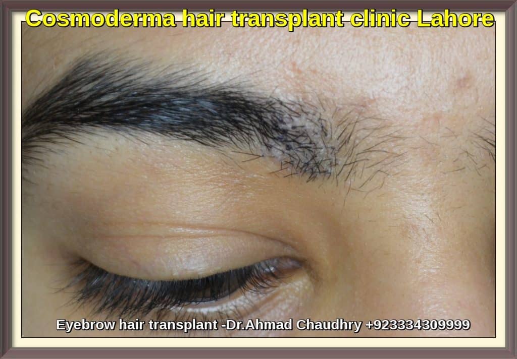 Eyebrow hair transplant clinic Pakistan- Dr Ahmad Chaudhry