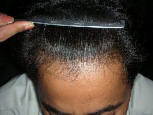 Hair transplant Lahore photo