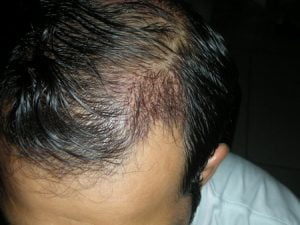 Hair Transplant in London photo