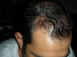 London hair transplant Photo