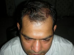 Hair Transplant London Photo