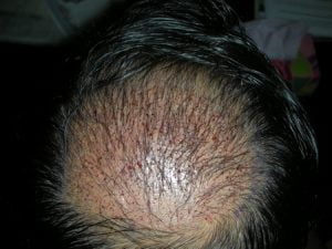 Hair Transplant surgery London Photo