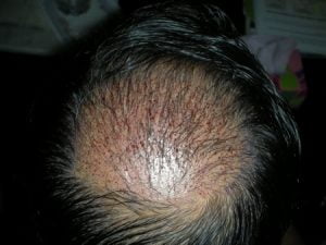 Crown area hair transplants london