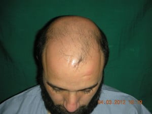 Fue procedure 