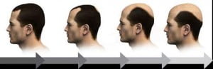 Hair transplant in Mecca Jeddha Riyadh