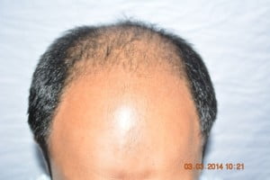 Before frontal hair restoration in Paris