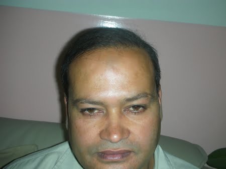 hair Transplantation kasur photo