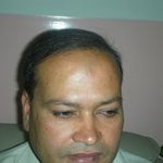 hair implant lahore photo