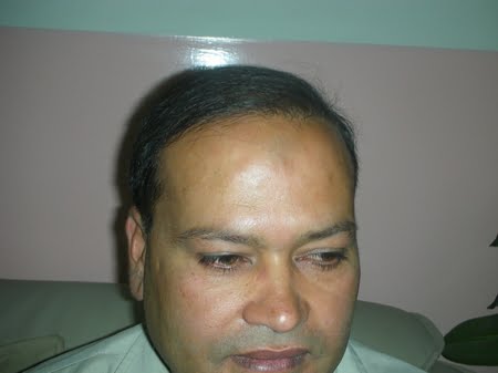 hair implant lahore photo