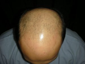 Hair transplant in Hyderabad photo