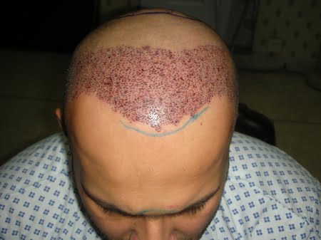 Hair Transplant in Hyderabad Pakistan- Fue Clinic for hair restoration