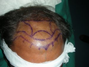 Hair transplant in gujranwala photo