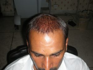Hair transplantation Gujranwala photo