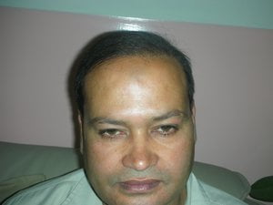 hair restoration in japan pictures