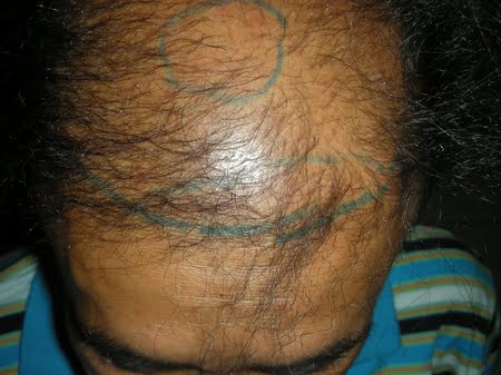 Hair Transplant in Bahawalpur Photo