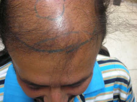 Hair Transplant Bahawalpur Photo