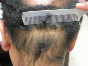 Hair Transplantation in Bahawalpur Photo