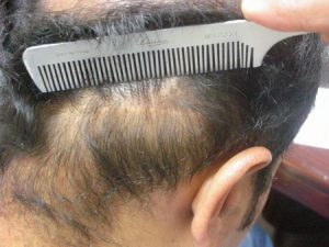 Hair Transplant surgery photo bahawalpur