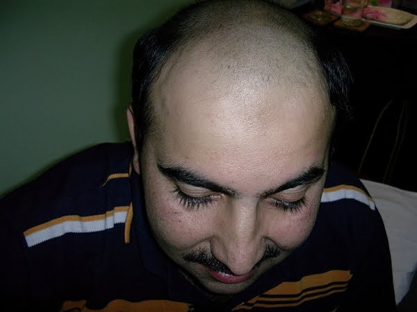 hair transplant before photo in syria