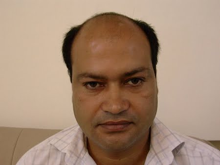 Hair transplant kasur photo