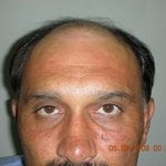 Hair Transplantation South Africa
