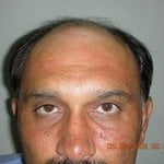 Hair Transplantation South Africa