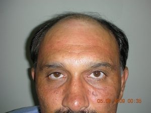 Hair transplant Multan photo