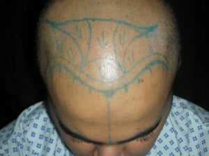 Hair Transplant in Riyadh