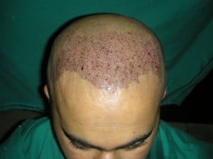 FUE hair transplant in Riyadh