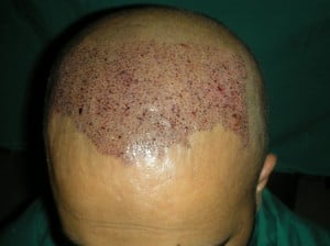 Follicle unit Extraction Saudia Arabia Riyadh