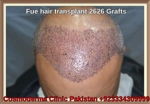 Fue hair transplant 2626 grafts sharjah Post op day