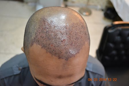 Fue hair transplant Paris France