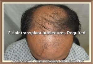 Fue hair transplant in Sharjah