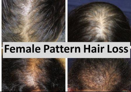 Hair loss women Pakistan Lahore