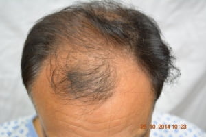 Hair transplant Japan