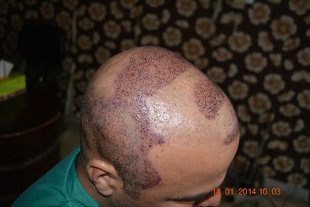 Hair transplant Lahore