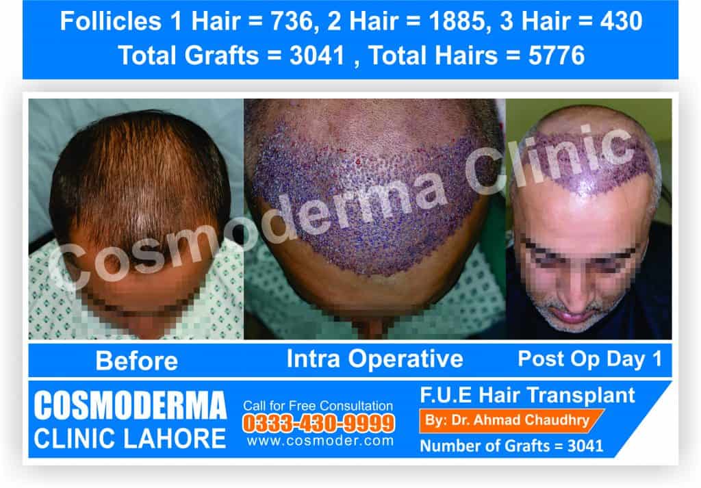 Hair transplant in Afghanistan