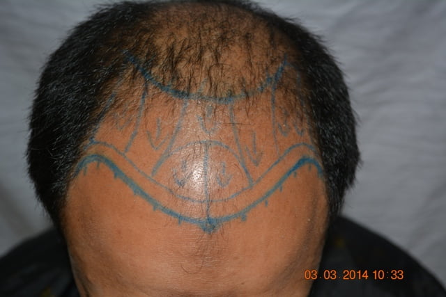 Hair transplant in Paris France