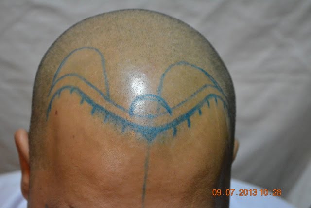 Hair transplant cost in Singapore