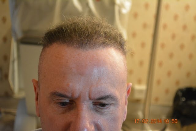 Laser hair transplant Lahore Pakistan