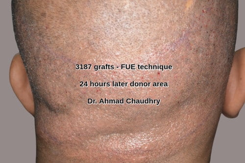 Natural hair transplant Pakistan