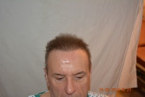 Pakistan hair transplantation