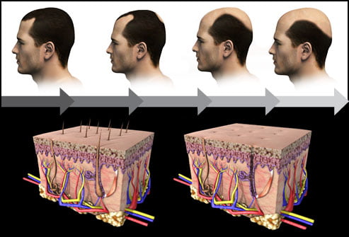 Hair transplant Bahamas