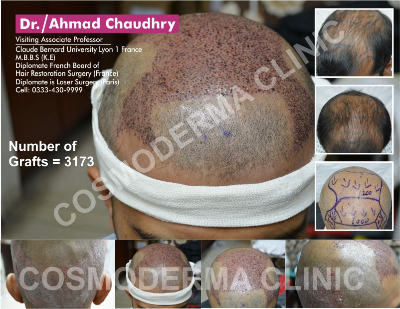 hair transplant in Sargodha