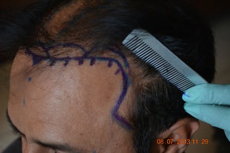 hair loss treatments in Pakistan