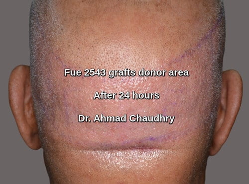 2543 grafts donor area