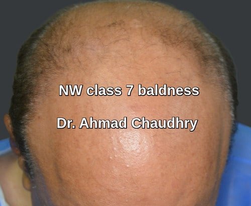 Baldness treatment Iran patient