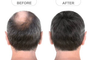 Before and after results crown