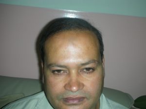 hair transplantation in mirpur photo