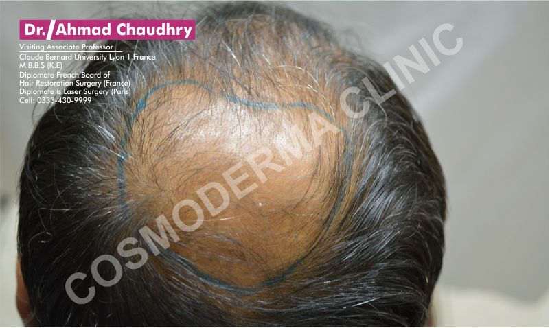 Crown area baldness treatment Pakistan
